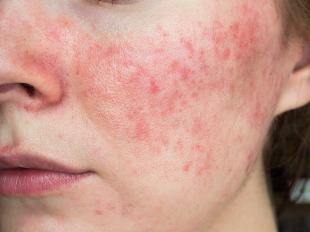 papulopustular rosacea, close-up of the patient’s cheek