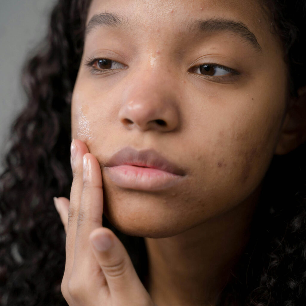 acne-1-scaled